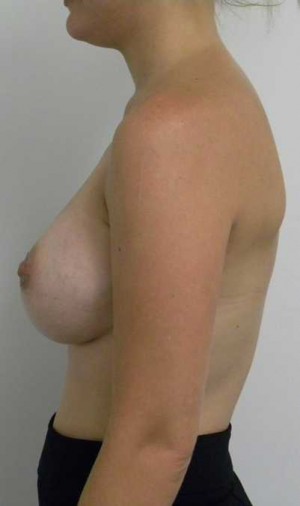 Breast Augmentation