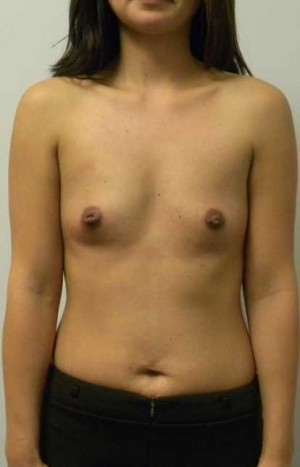 Breast Augmentation