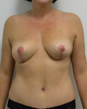 Breast Lift